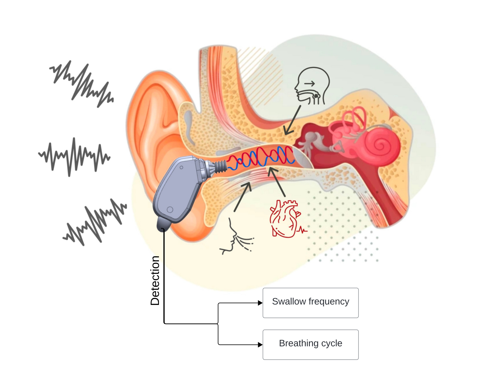 Detection of swallowing and breathing using an in-ear microphone  image